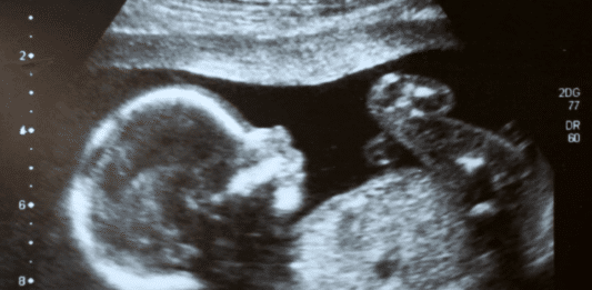 Ultraschallbild eines Kindes im Bauch seiner Mutter.